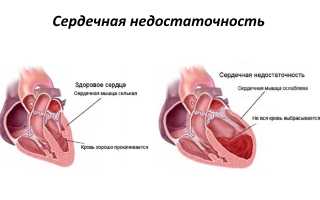 Сердечная недостаточность — причины, симптомы, лечение, диагностика, прогноз и профилактика