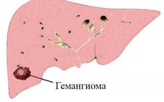 Гемангиома печени — лечение, удаление и причины появления