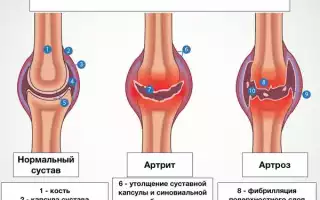 Дегенеративные изменения суставов