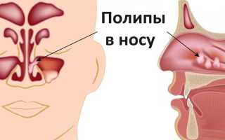 Безоперационное лечение полипов в носу