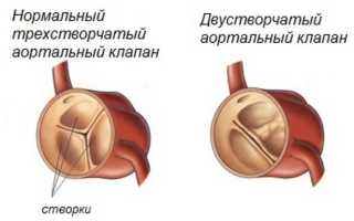 Лечение и прогноз жизни при двустворчатом аортальном клапане