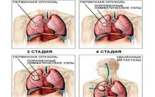 Лечение и симптомы рака легких 4 стадии