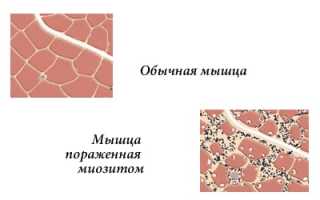 Миозит грудной клетки – суть и особенности болезни