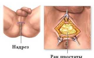 Рак предстательной железы: стадии, лечение и прогноз