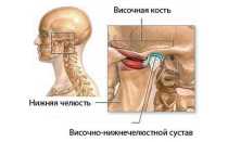 Остеоартроз челюстного сустава
