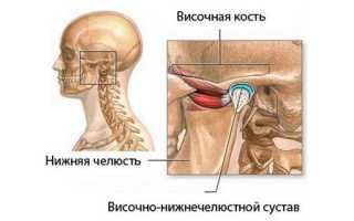 Остеоартроз челюстного сустава
