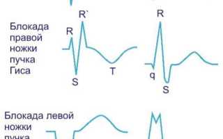 Блокада ножек пучка Гиса — правая, левая, полная и неполная