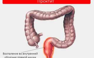 Проктит — причины, симптомы, лечение и диагностика
