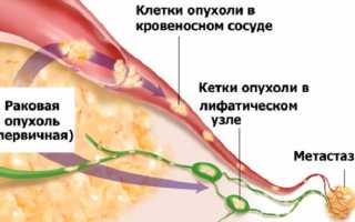 Особенности мелкоклеточного рака легких
