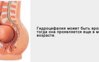 Диагностика и лечение гидроцефалии головного мозга у детей