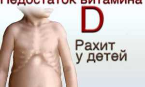 Рахит у детей симптомы и лечение