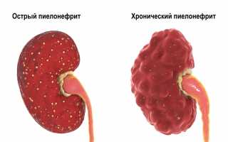 Острый пиелонефрит — симптомы, причины, диагностика и лечение