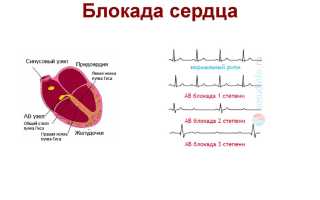 Блокада сердца — причины, симптомы, лечение, степени и имплантация кардиостимулятора