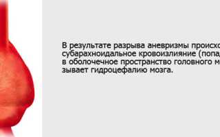 Симптомы и последствия разрыва аневризмы головного мозга