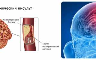 Ишемический инсульт — причины, симптомы, лечение, восстановление, последствия и профилактика