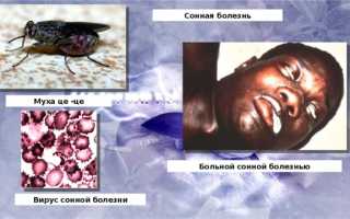 Что такое сонная болезнь и как ее лечить?
