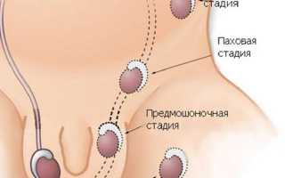 Крипторхизм у мальчиков