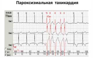 Пароксизмальная тахикардия — причины, симптомы и лечение