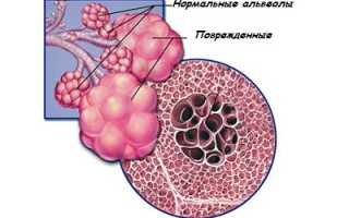 Как и почему возникает ХОБЛ?
