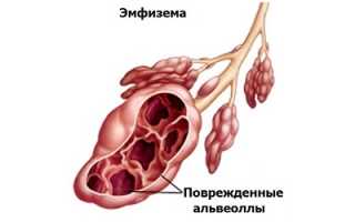 Лечение эмфиземы легких в домашних условиях