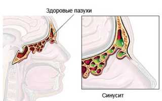 Особенности применения капель в нос Галазолин и чем заменить препарат?
