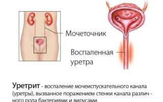 Цистит в уретре: основные симптомы и лечение патологии