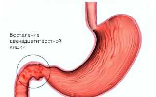 Бульбит — лечение, диета и симптомы