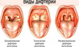 Дифтерия — симптомы, лечение, профилактика и прививка