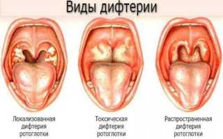 Дифтерия — симптомы, лечение, профилактика и прививка