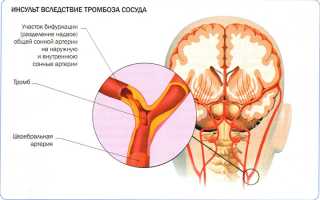 Основные отличия инсульта и инфаркта