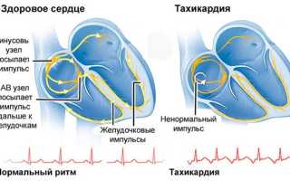 Тахикардия — симптомы, причины, приступы, лечение и профилактика
