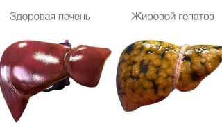 Гепатоз печени — симптомы и лечение, в том числе жирового гепатоза печени
