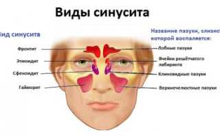 Хронический синусит: симптомы и лечение