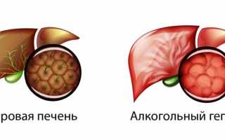Что такое алкогольный гепатит и как его лечить