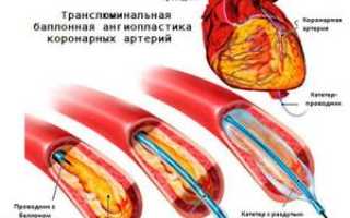 Коронарная ангиопластика и стентирование коронарных артерий