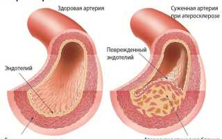 Лечения атеросклероза сосудов головного мозга народными средствами