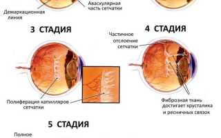 Советы неонатолога: как вовремя распознать и вылечить ретинопатию недоношенных