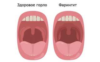 Фарингит — симптомы и лечение