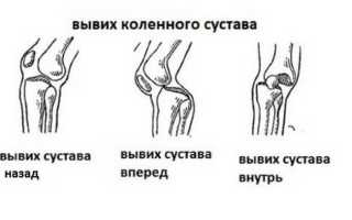 Что делать при вывихе колена