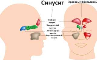 Симптомы и лечение синусита у детей