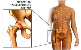 Чем лечить коксартроз тазобедренного сустава