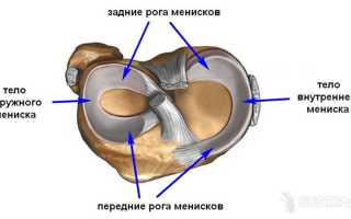 Повреждение переднего рога медиального мениска