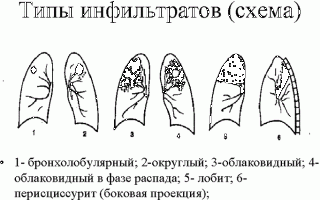 Инфильтрат в легких