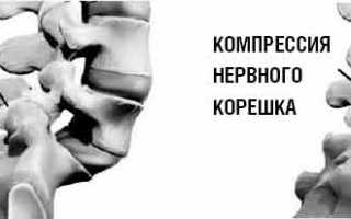 Остеохондроз спондилоартроз