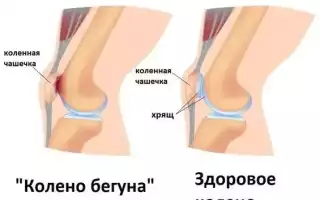 Боль в коленном суставе при ходьбе