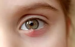 Как лечить ячмень на глазу