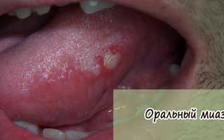 Факторы, которые провоцируют развитие Оральных миаз у людей