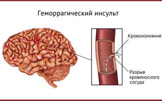 Особенности лечения геморрагического инсульта