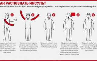 Симптомы и первые признаки инсульта