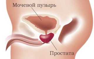Киста предстательной железы у мужчин: причины, лечение и последствия